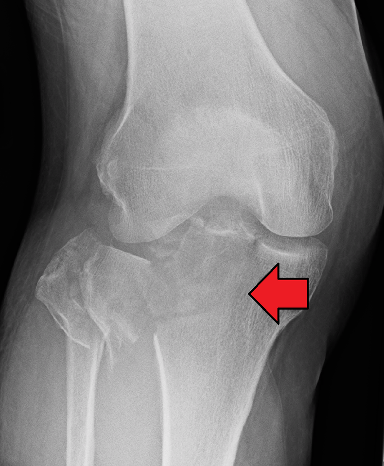 перелом колена рентген