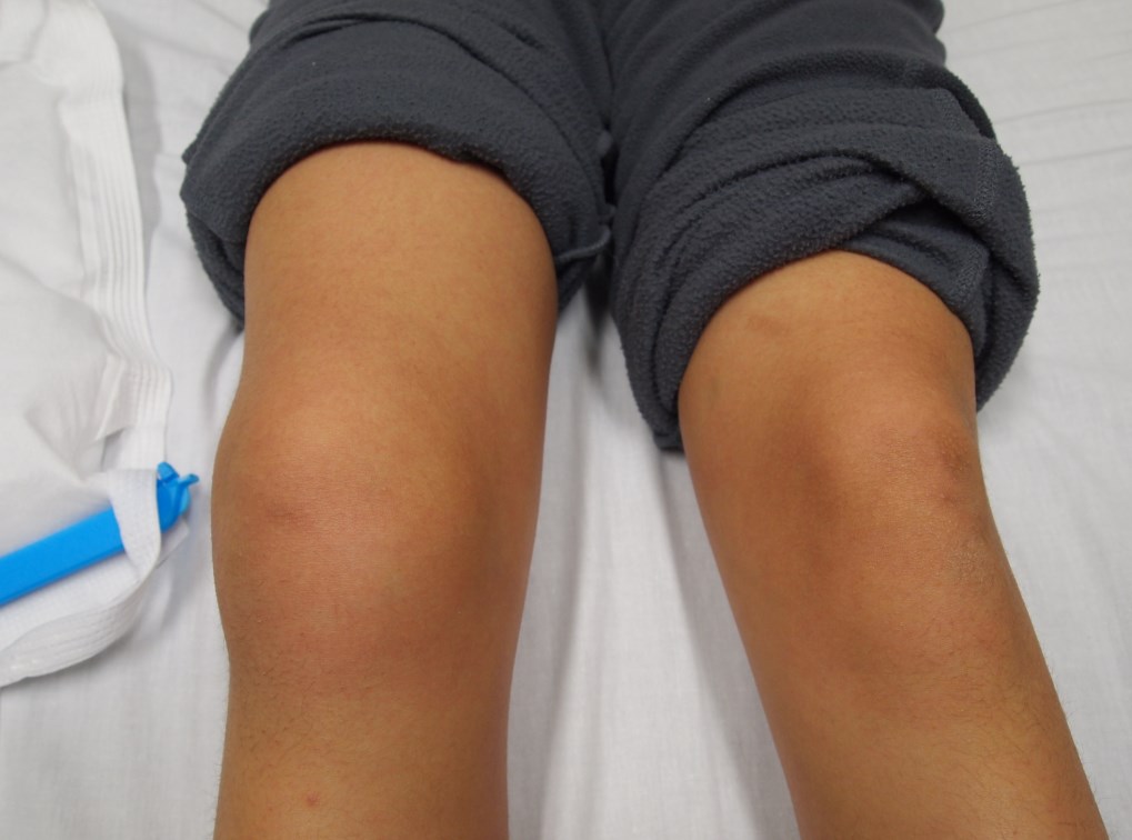 перелом колена