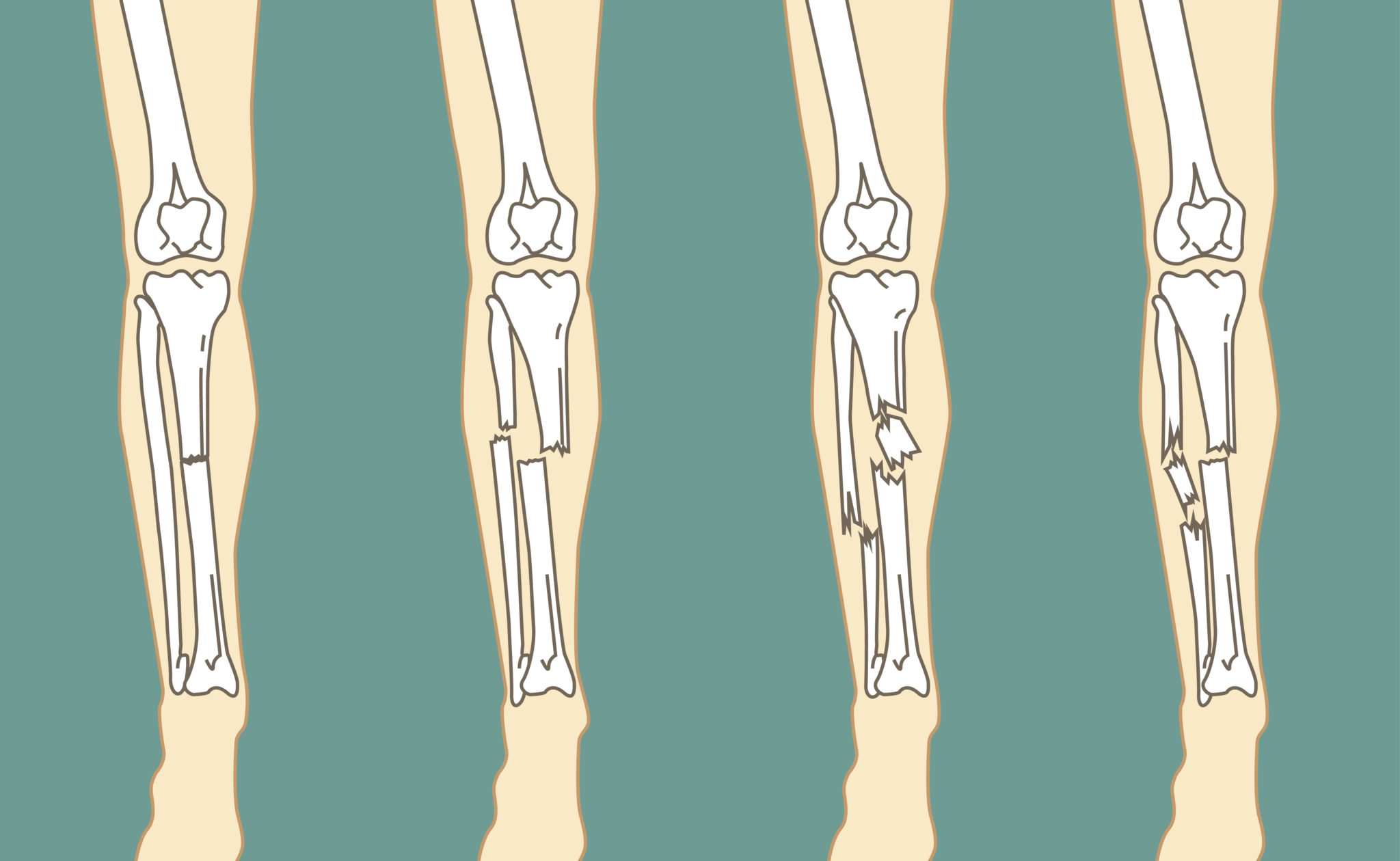 перелом ноги
